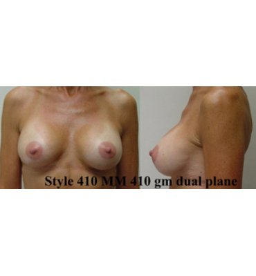 Breast Augmentation Ptosis After